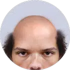 Bald Face