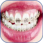 Fake Braces